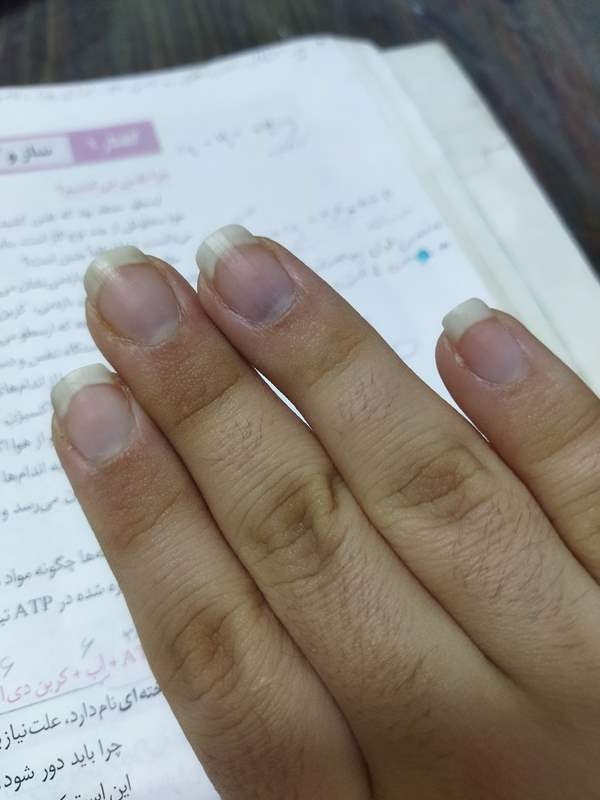 کبودی ناخن بر اثر کم بودن اکسیژن خون Image